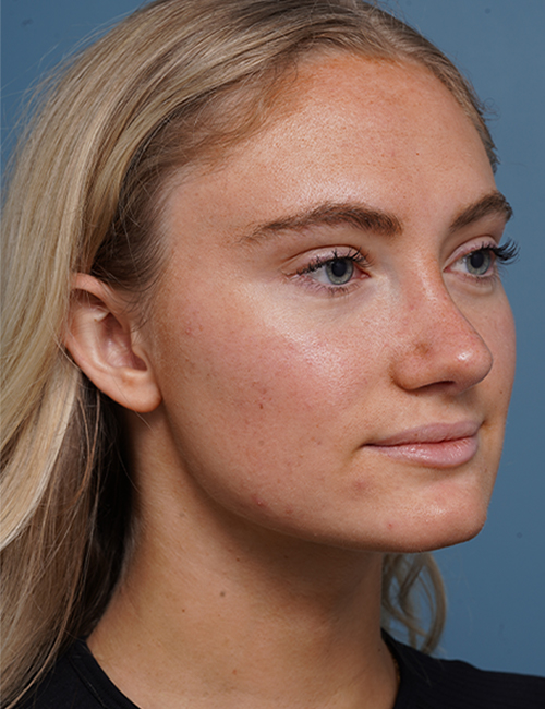 after rhinoplasty right angle view female patient case 1711