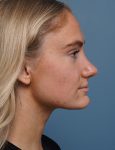 after rhinoplasty right side view female patient case 1711