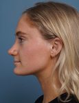 after rhinoplasty left side view female patient case 1711