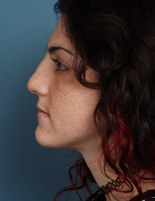 before rhinoplasty left side view female patient case 1724