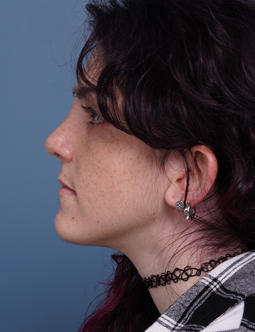 after rhinoplasty left side view female patient case 1724