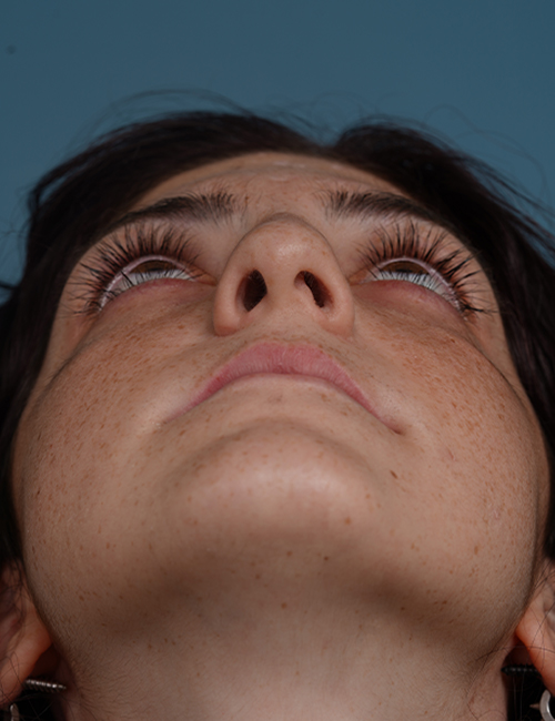 before rhinoplasty front heads up view female patient case 1724