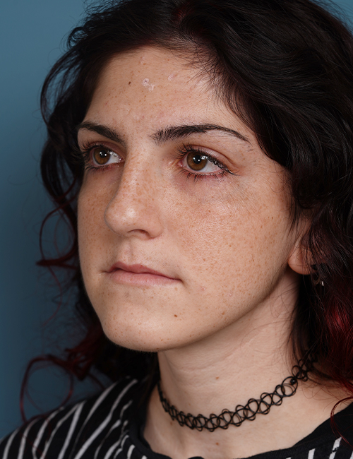 before rhinoplasty left angle view female patient case 1724