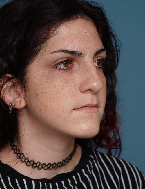 before rhinoplasty right angle view female patient case 1724