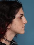 before rhinoplasty right side view female patient case 1724