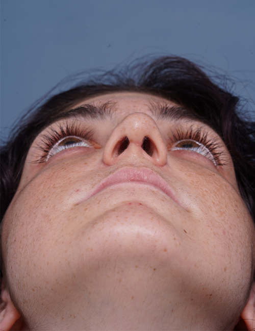 after rhinoplasty front heads up view female patient case 1724
