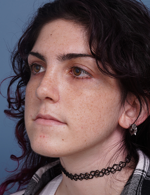 after rhinoplasty left angle view female patient case 1724