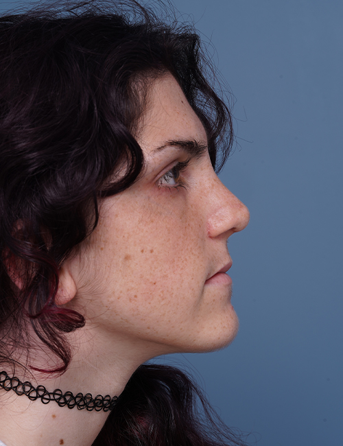 after rhinoplasty right side view female patient case 1724