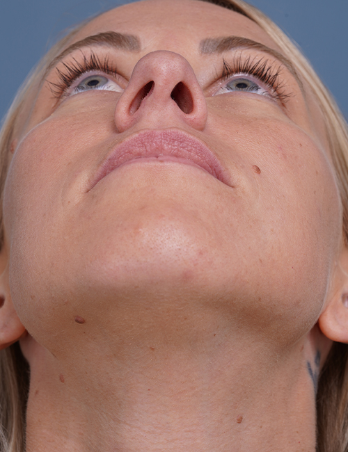 before rhinoplasty front head up view female patient case 1737