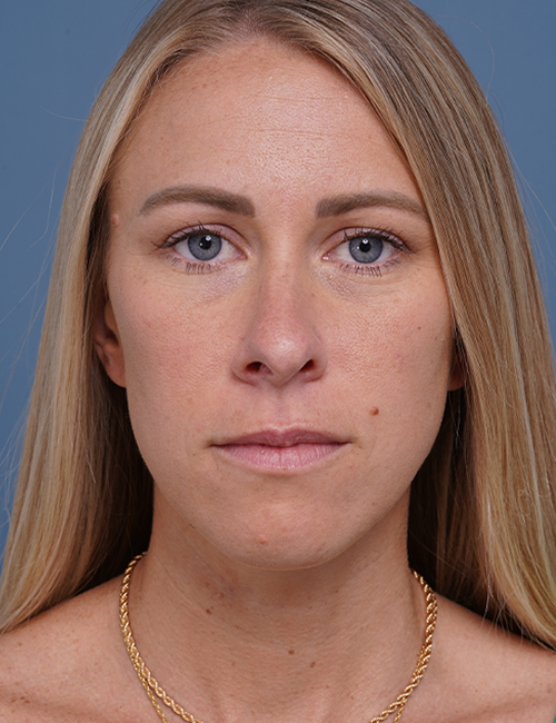 before rhinoplasty front view female patient case 1737