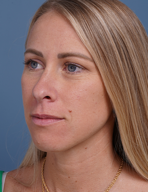 before rhinoplasty left angle view female patient case 1737