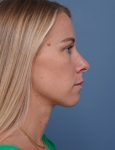 before rhinoplasty right side view female patient case 1737