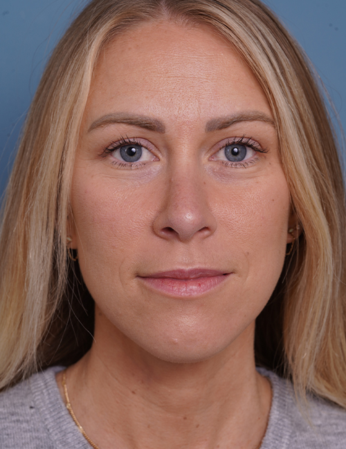 after rhinoplasty front view female patient case 1737