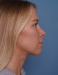 after rhinoplasty right side view female patient case 1737