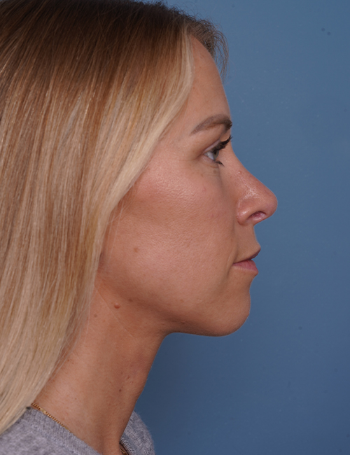 after rhinoplasty right side view female patient case 1737