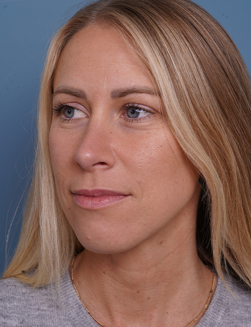 after rhinoplasty left angle view female patient case 1737