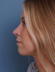 after rhinoplasty left side view female patient case 1737