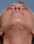 after rhinoplasty front head up view female patient case 1737