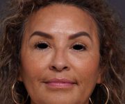 after brow lift front view female patient case 2088