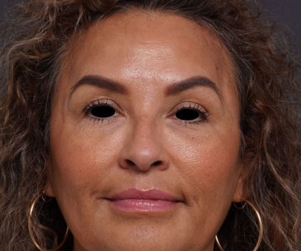 after brow lift front view female patient case 2088