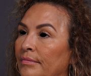 after brow lift left angle view female patient case 2088