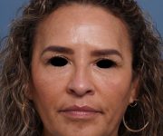before brow lift front view female patient case 2088