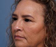 before brow lift left angle view female patient case 2088