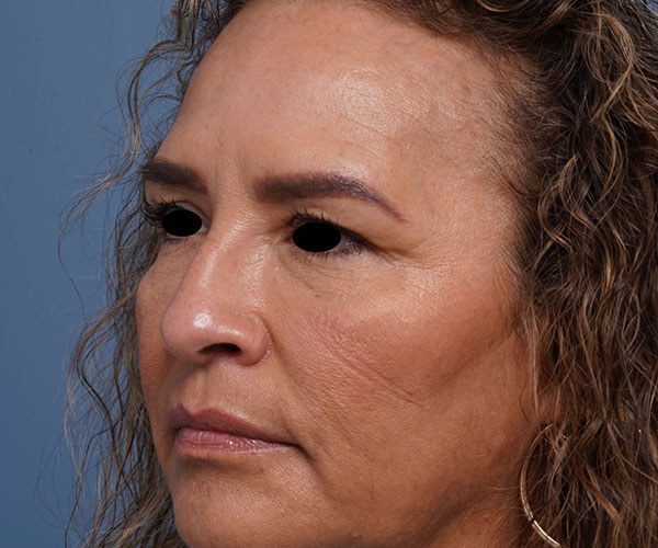 before brow lift left angle view female patient case 2088