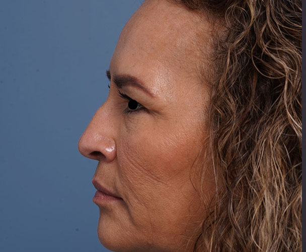 before brow lift left side view female patient case 2088