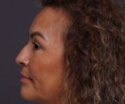 before brow lift left side view female patient case 2088