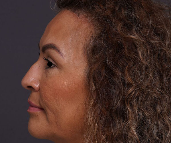 before brow lift left side view female patient case 2088