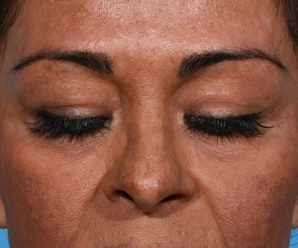 before brow lift front eyes closed view female patient case 2103
