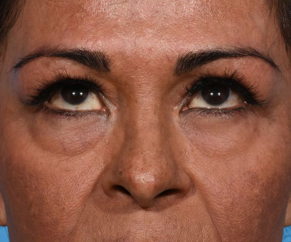 before brow lift front eyes up view female patient case 2103
