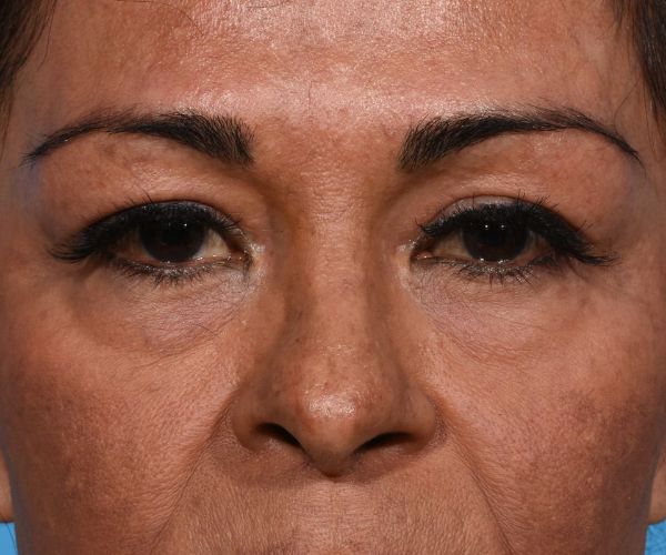 before brow lift front view female patient case 2103