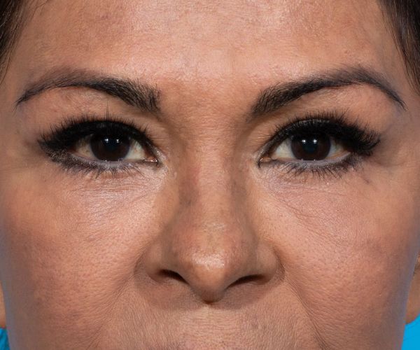 after brow lift front view female patient case 2103