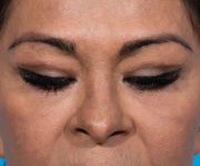 after brow lift front eyes closed view female patient case 2103