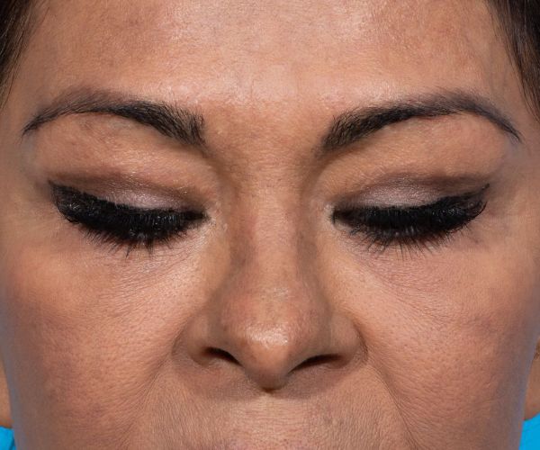 after brow lift front eyes closed view female patient case 2103