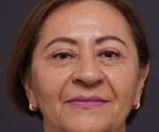 after brow lift front view female patient case 2116