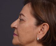 after brow lift left side view female patient case 2116