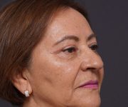 after brow lift right angle view female patient case 2116