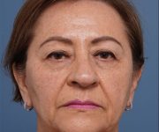 before brow lift front view female patient case 2116