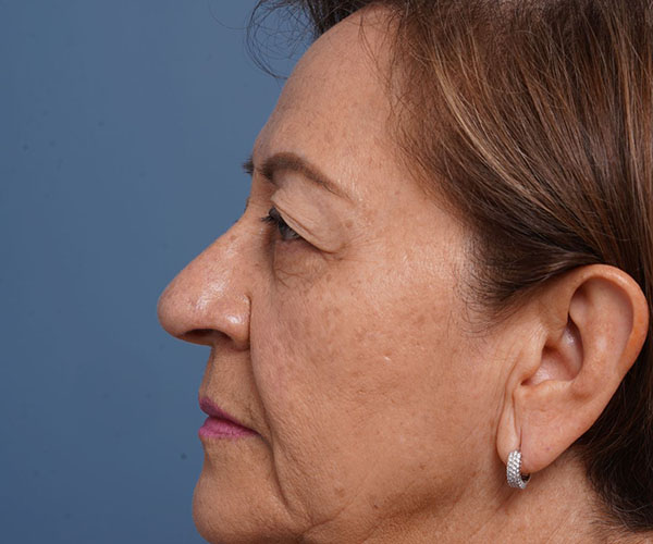 before brow lift left side view female patient case 2116