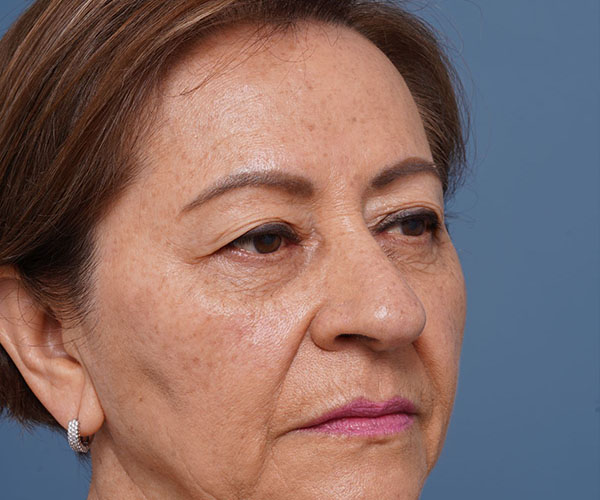 before brow lift right angle view female patient case 2116