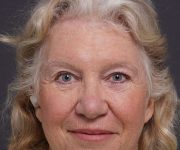 after brow lift front view female patient case 2123