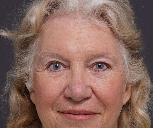 after brow lift front view female patient case 2123