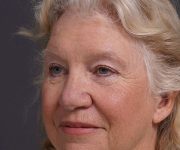 after brow lift left angle view female patient case 2123