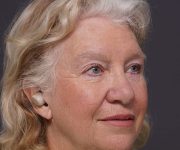 after brow lift right angle view female patient case 2123