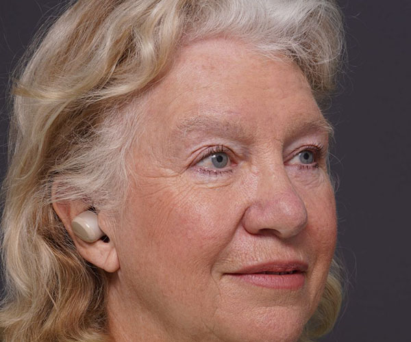 after brow lift right angle view female patient case 2123