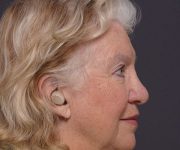 after brow lift right side view female patient case 2123