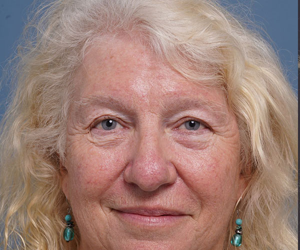 before brow lift front view female patient case 2123